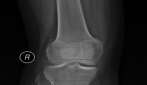 Gambar pengukuran sendi lutut (Foto: dokumentasi Suyitno)