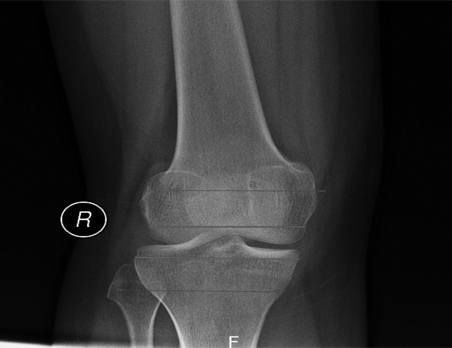 Gambar pengukuran sendi lutut (Foto: dokumentasi Suyitno)