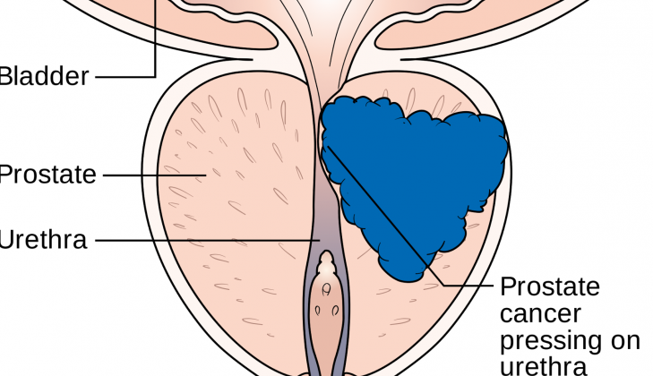 Ilustrasi Kanker Prostat (sumber:sembuhkan-penyakit.blogspot.co.id)